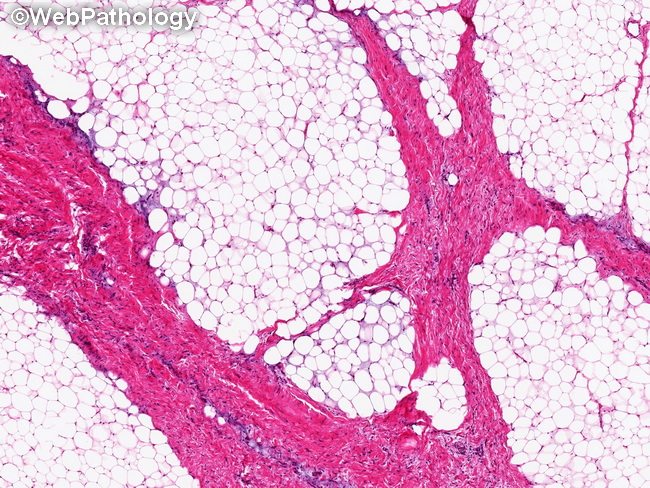 Soft Tissue_Lipomatous_Lipoblastoma29_resized.jpg